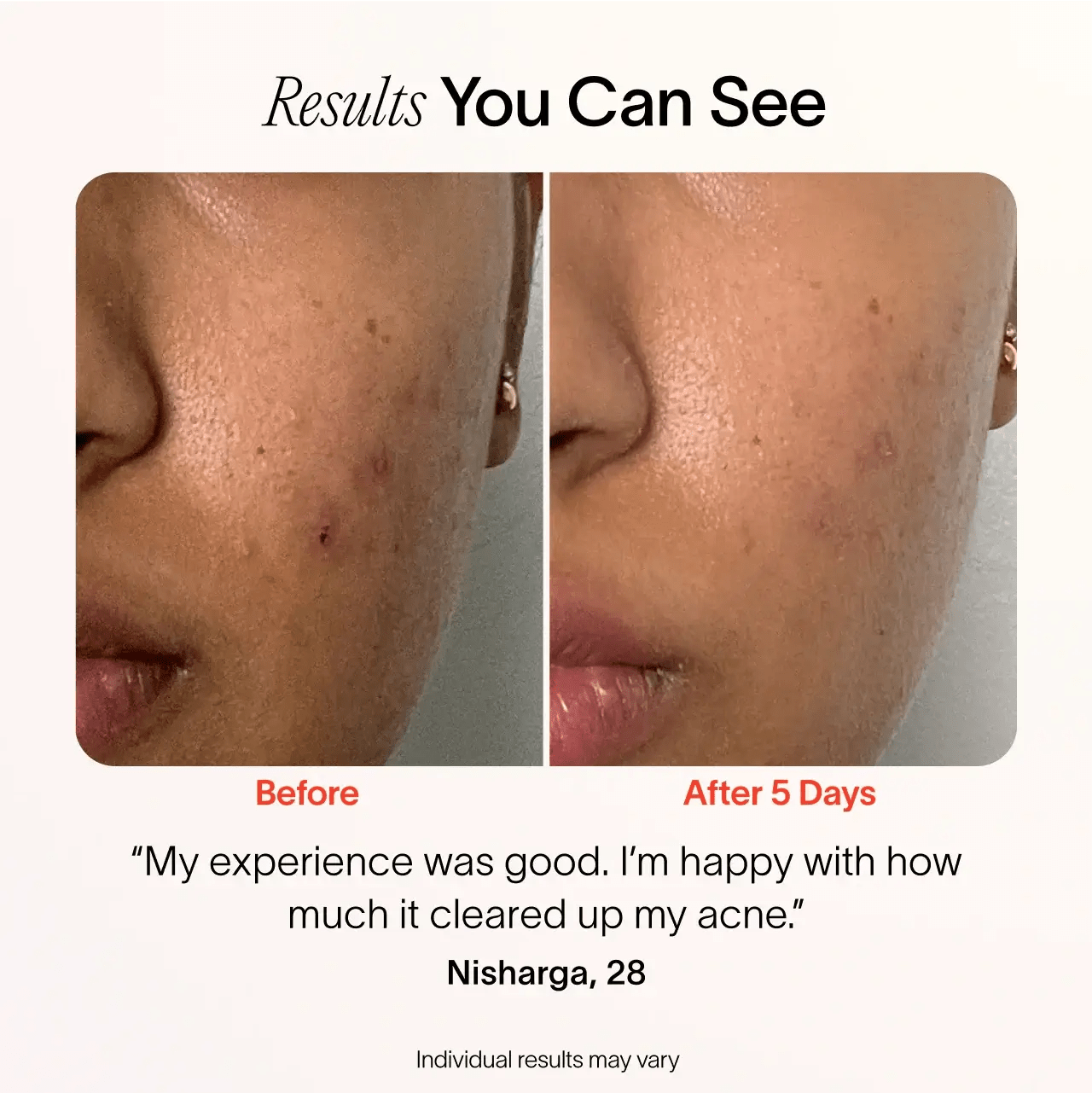 Bye Acne: 3 - Minute Pimple Spot Treatment Solawave