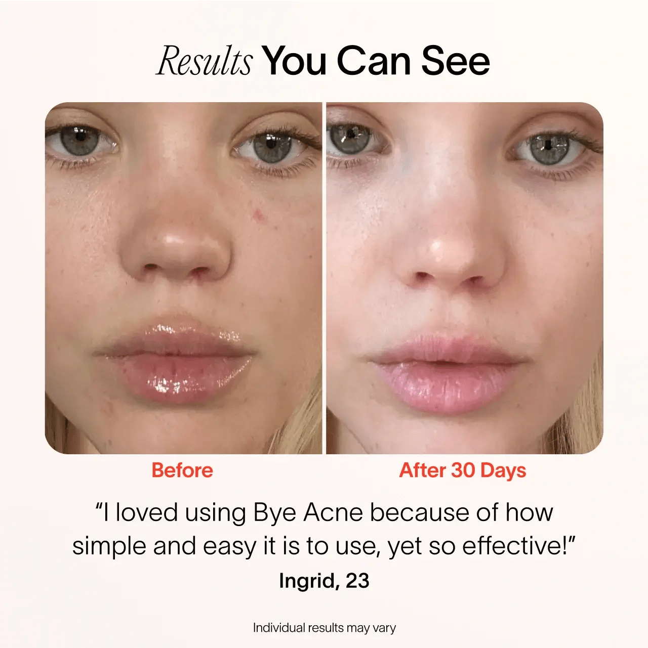 Bye Acne: 3 - Minute Pimple Spot Treatment Solawave