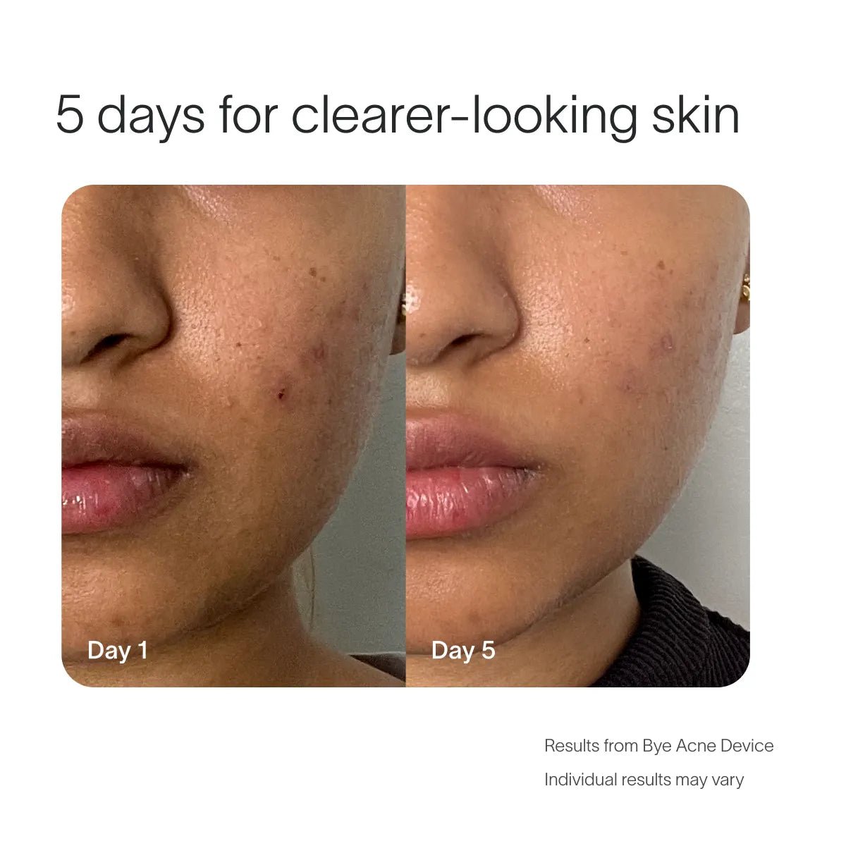 Bye Acne Pro Kit Solawave