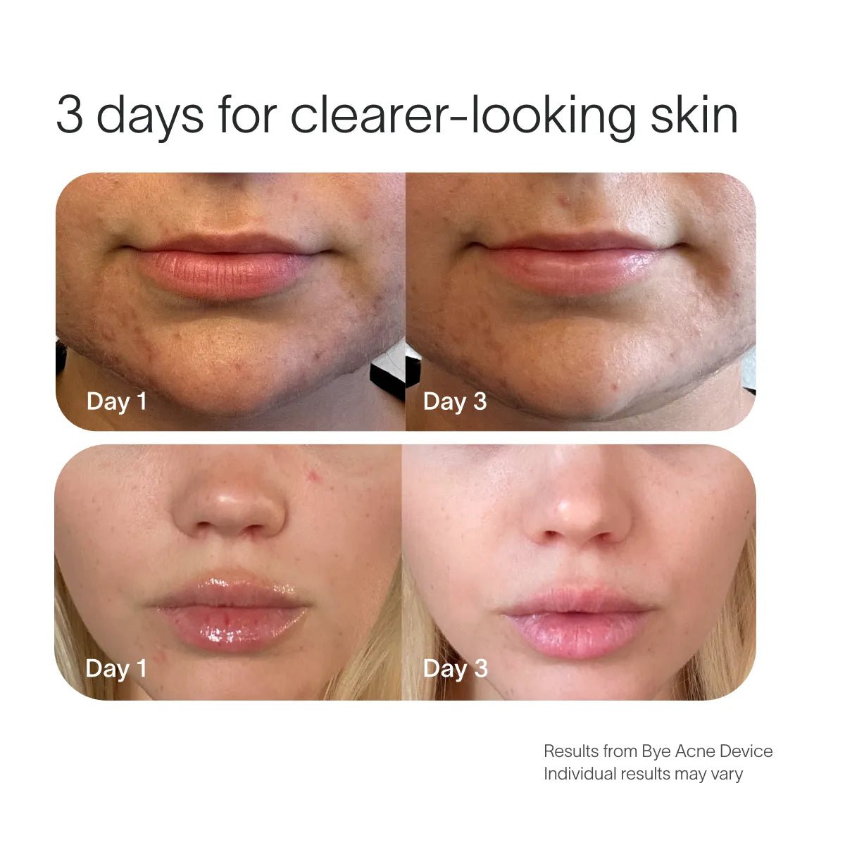 Bye Acne Pro Kit Solawave